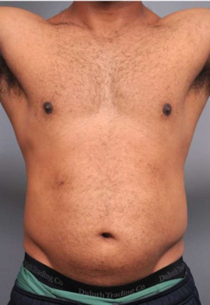 Liposuction Before & After Patient #626