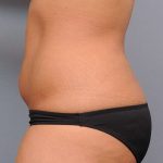 Liposuction Before & After Patient #635