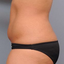 Liposuction Before & After Patient #635