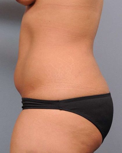 Liposuction Before & After Patient #635