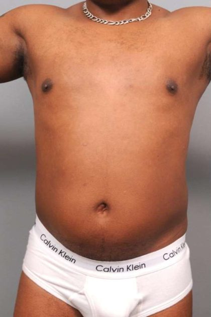 Liposuction Before & After Patient #648