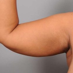 Liposuction Before & After Patient #655