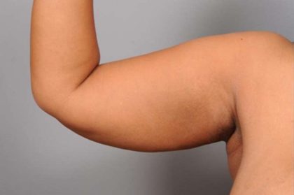 Liposuction Before & After Patient #655