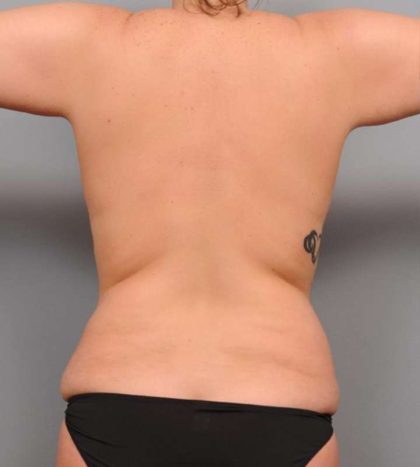 Liposuction Before & After Patient #662