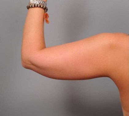 Liposuction Before & After Patient #669