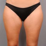 Liposuction Before & After Patient #674