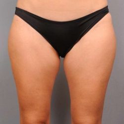 Liposuction Before & After Patient #674