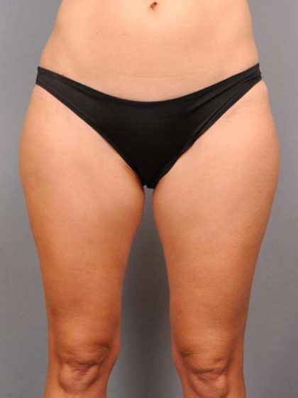 Liposuction Before & After Patient #674