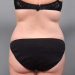 Liposuction Before & After Patient #681