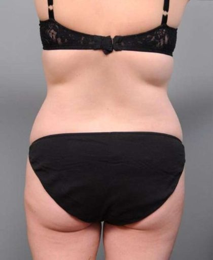 Liposuction Before & After Patient #681