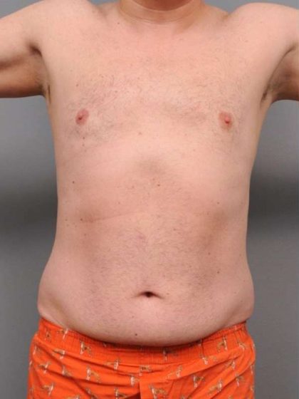 Liposuction Before & After Patient #688