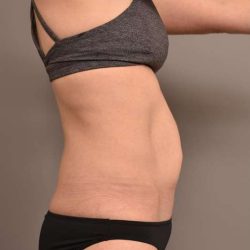 Tummy Tuck Before & After Patient #263