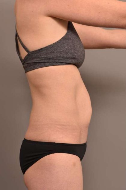 Tummy Tuck Before & After Patient #263