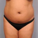 Liposuction Before & After Patient #695