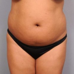 Liposuction Before & After Patient #695