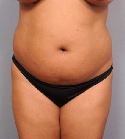Liposuction Before & After Patient #695