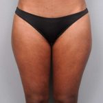 Liposuction Before & After Patient #709