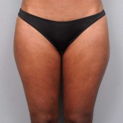 Liposuction Before & After Patient #709