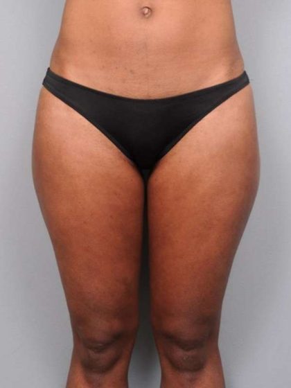 Liposuction Before & After Patient #709