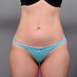 Liposuction Before & After Patient #716