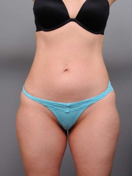 Liposuction Before & After Patient #716