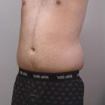 Liposuction Before & After Patient #721