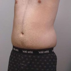 Liposuction Before & After Patient #721