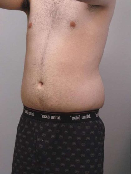 Liposuction Before & After Patient #721
