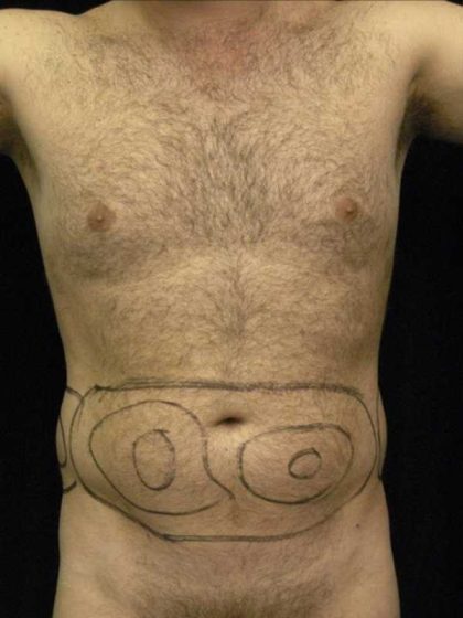 Liposuction Before & After Patient #726