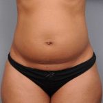 Liposuction Before & After Patient #738