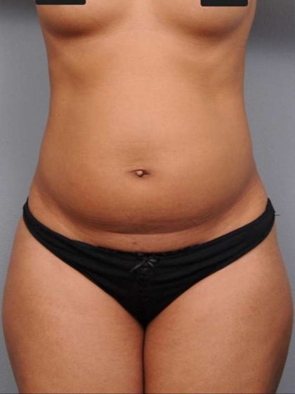Liposuction Before & After Patient #738