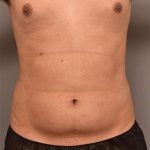 Liposuction Before & After Patient #749