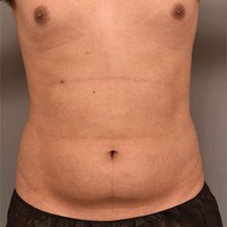 Liposuction Before & After Patient #749