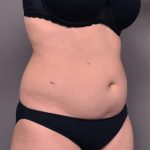 Liposuction Before & After Patient #756