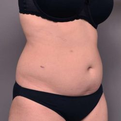 Liposuction Before & After Patient #756