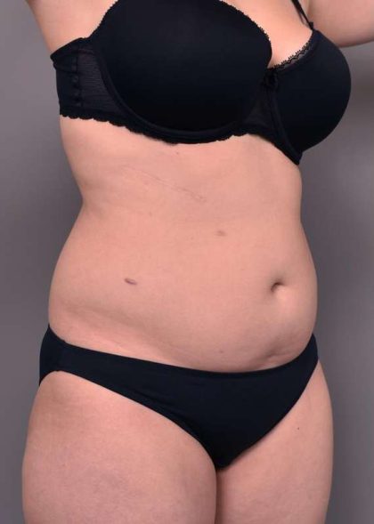 Liposuction Before & After Patient #756