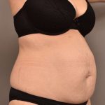 Tummy Tuck Before & After Patient #266
