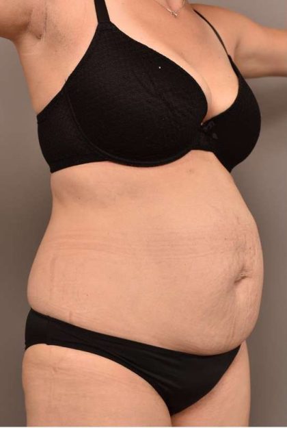 Tummy Tuck Before & After Patient #266