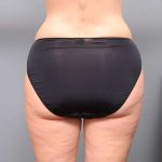 Liposuction Before & After Patient #761