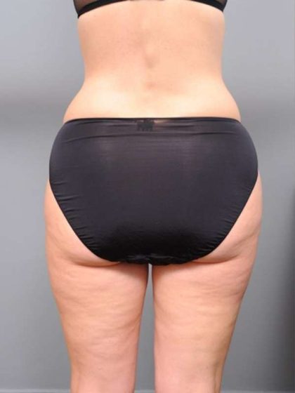 Liposuction Before & After Patient #761