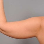 Liposuction Before & After Patient #768