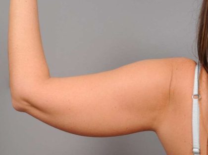 Liposuction Before & After Patient #768