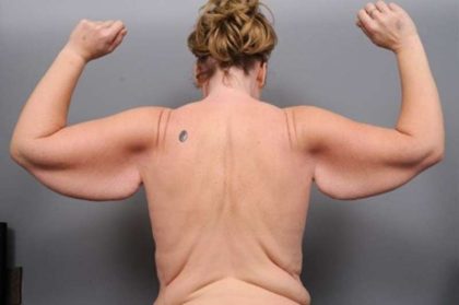 Arm Lift Before & After Patient #795