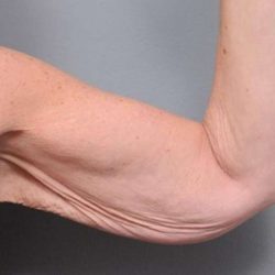 Arm Lift Before & After Patient #800