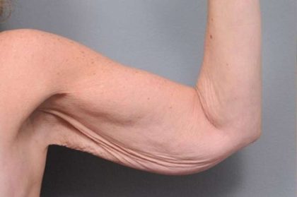 Arm Lift Before & After Patient #800