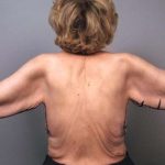 Arm Lift Before & After Patient #807