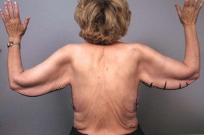 Arm Lift Before & After Patient #807