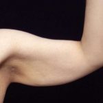 Arm Lift Before & After Patient #814