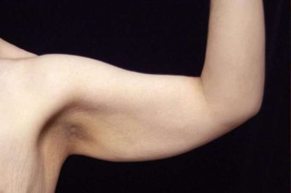 Arm Lift Before & After Patient #814