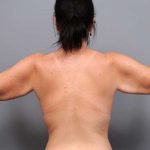 Arm Lift Before & After Patient #819